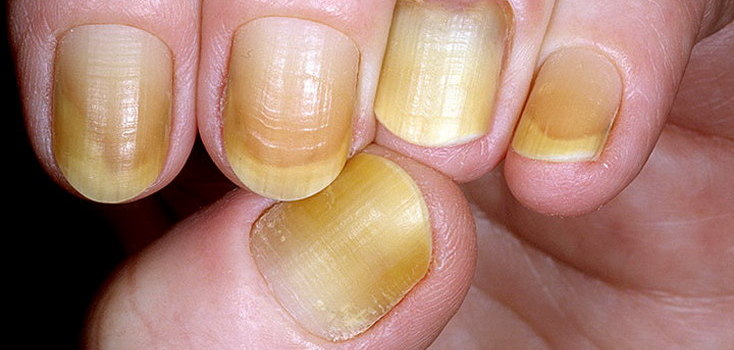 तपाईको नङले बताउछ स्वास्थ्य स्थिती, कस्तो छ तपाईको नङ र ?