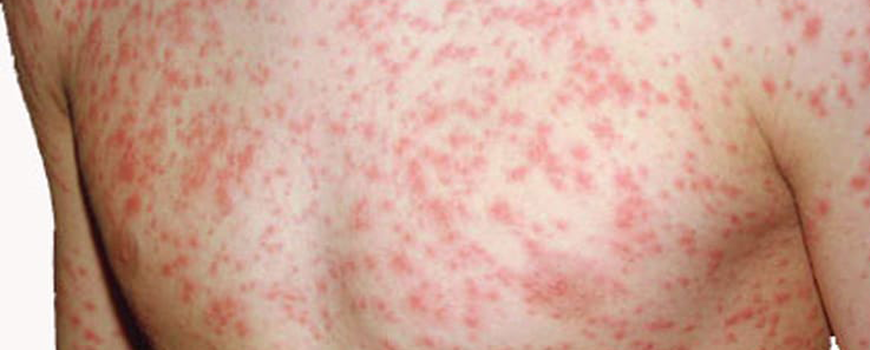 नेपालगन्जमा फैलियो दादुरा महामारी, १ बालकको दादुराबाट मृत्यु